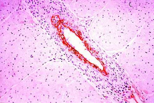 الإسهال الفيروسي البقري Bovine Viral Diarrhea : صبغة كيمياء الانسجة المناعية لفيروس الأسهال البقري(البروتين التركيبي و غير تركيبي ) في القلب