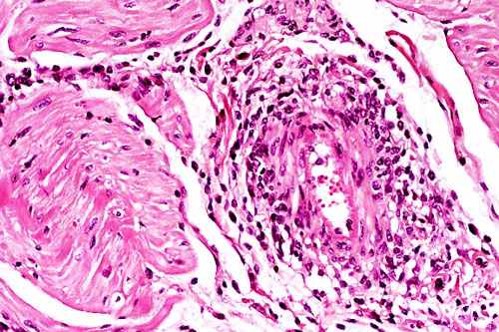 الإسهال الفيروسي البقري Bovine Viral Diarrhea : تخلل الليمفاويات وقليل من النسيجيات و نادرا المتعادلات في و حول جدار الوعاء الدمي في القلب