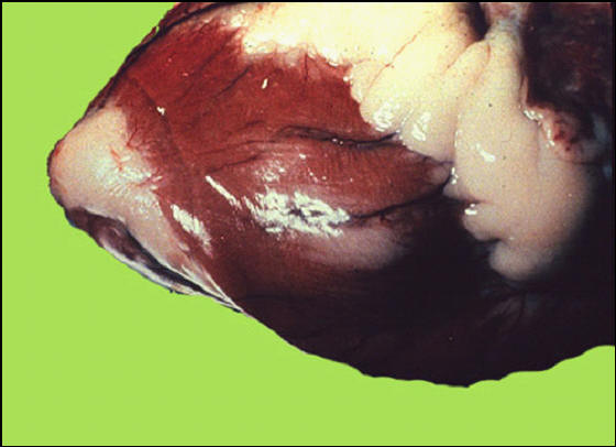 Foot and mouth diseases حمى قلاعية : بقرة - خطوط بيضاء من الموات فى عضلة البطين .