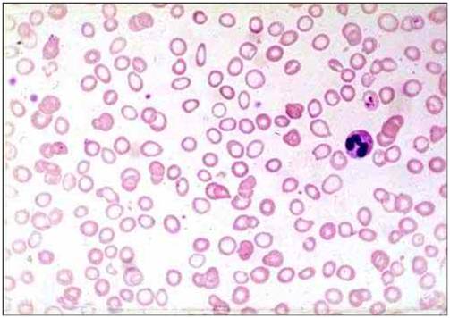 فقر دم نقص الحديد (1) : صورة الدم لفقر دم نقص الحديد
