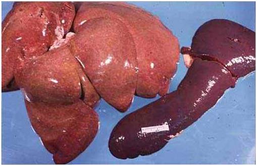 فقر دم ضغط النخاع المصاحب لسرطان الدم صورة (1) : الكبد والطحال في حالة ابيضاض الدم