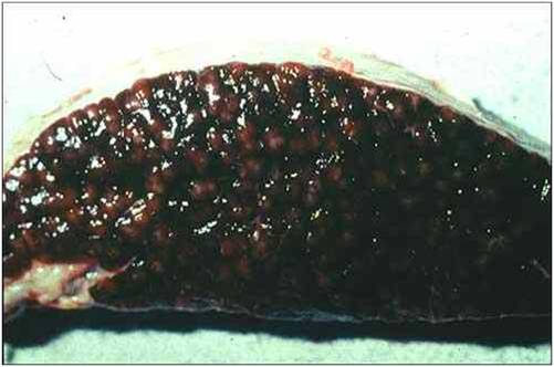 فقر الدم (10) : الطحال : فرط النمو (hyperplasia) حدد دموى (hemosiderosis)