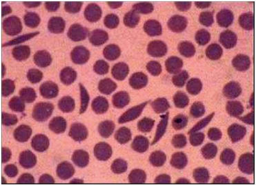 فقر الدم (21) : كريات دم حمراء منجلية