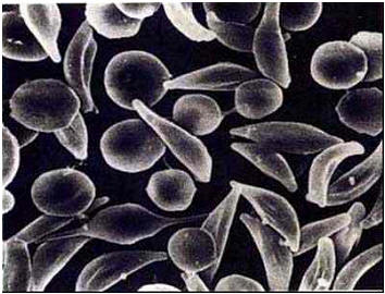 فقر الدم (22) : مجهر الكتروني مجسم .. كريات دم حمراء منجلية