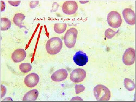 فقر الدم (33) : اختلاف الحجم لكريات الدم الحمراء (anisocytosis)