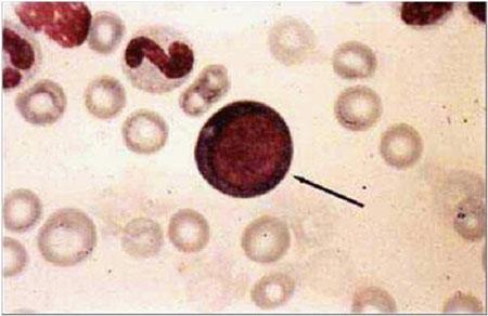 فقر الدم (34) : المضرجات الدائرة (Circulating rubricytes)
