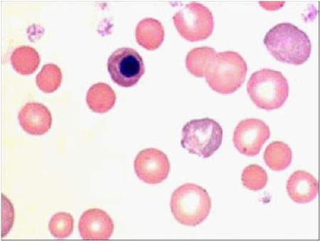 فقر الدم (36) : الصبغية المختلطة (Polychromasia)
