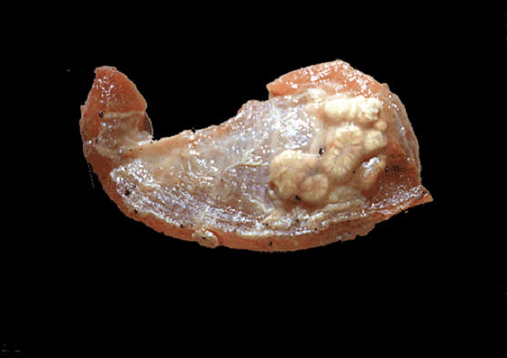tuberculosis صورة( 15 ) : حبيبومات السل في جلد بقرة عقد تحت الجلد قاسية القوام ونسيج مائت اصفر 