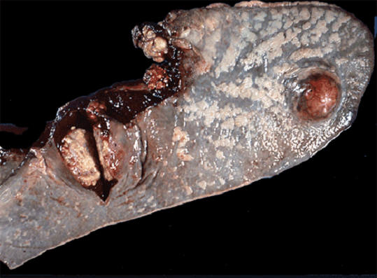  tuberculosis صورة( 24 ) : طحال بقرة سل الانتشار المتأخر