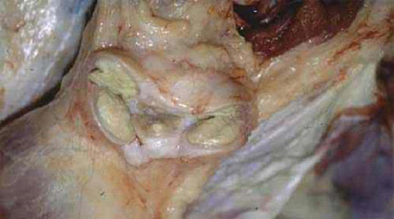 صورة (9) التهاب الغدة الليمفاويه المتجبن ( Caseous lymphadenitis) : خراريج السل الكاذب في غدة ليمفاوية لماعز 