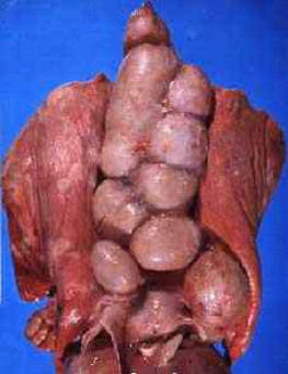 صورة (10) التهاب الغدة الليمفاويه المتجبن ( Caseous lymphadenitis) : غنمة مصابة بالتهاب الغدد الليمفاوية المتجبن - الرئة : مع الغدد الليمفاوية الشعبية والمنصفية 