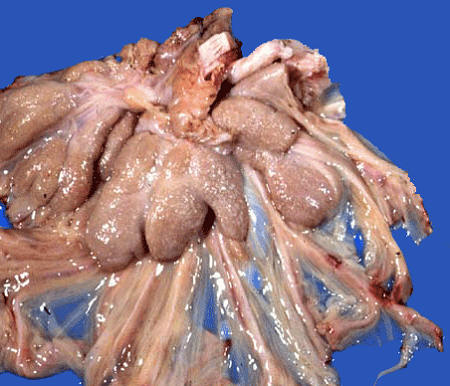 صورة (6) paratuberculosis : شبيه الدرن في امعاء غنمة تضخم الغدد الليمفاوية للمساريقا