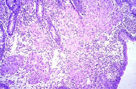 صورة (7) paratuberculosis : شبيه الدرن البقري في امعاء غنمة الصفيحة المخصوصة متمددة بصفائح من خلايا الظهارانيات الآكلة