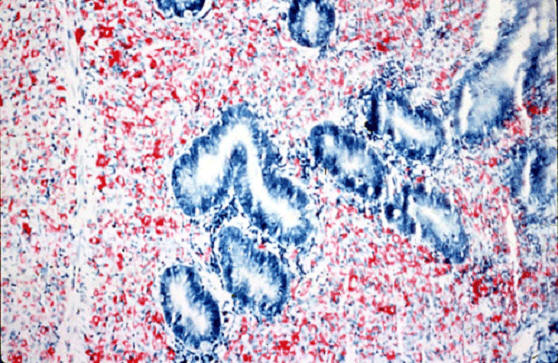 شبيه الدرن البصورة (8) paratuberculosis : قري في امعاء غنمة آلاف من العصويات البكتيرية مصبوغة في الاكلات بصبغة الزيل نلسون