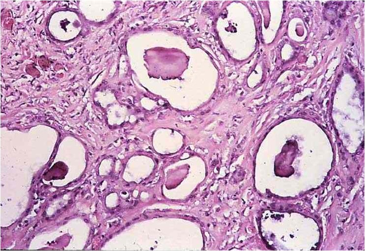 Adenomatous hyperplasia مشيمة الخيول : فرط النمو شبه الغددى لطلائيات اللقانقي