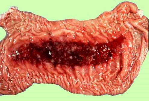 الإسهال الفيروسي البقري Bovine Viral Diarrhea : موات نزيفي للطع باير اللطعة مدممة و بها بقابا ليفين
