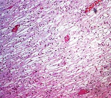 الإسهال الفيروسي البقري Bovine Viral Diarrhea : ليونة النسيج العصبي . تضخم وتجاويف المحاور
