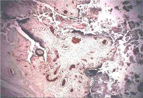 Chlamydiosis مشيمة نعجة مصابة بالمتدثرات : التهاب النسيج الضام وطبقة خلايا الامهات الغذائية