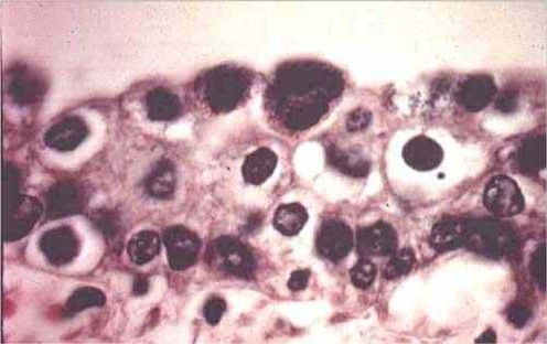 Chlamydiosis مشيمة نعجة مصابة بالمتدثرات : ميكروبات المتدثرات في خلايا الامهات الغذائية