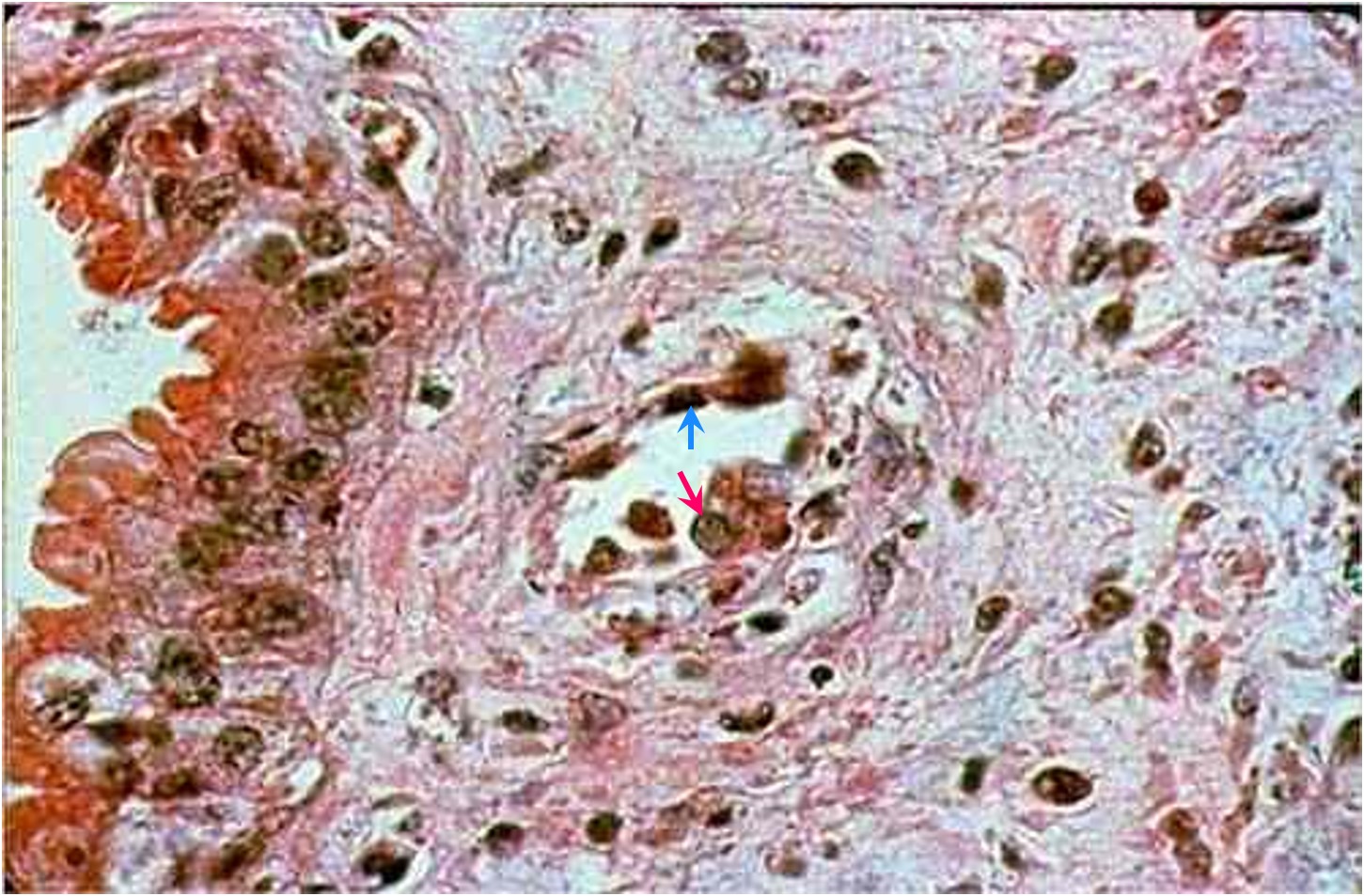 Viral abortion: Infectious bovine rhinotracheitis مشيمة بقرة مصابة بالتهاب الأنف و القصبة الهوائية البقري : موات الخلايا المبطنة للأوعية مع وجود اجسم احتوائية فيها