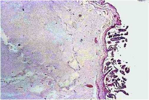 Infectious bovine rhinotracheitis مشيمة بقرة مصابة بالتهاب الأنف و القصبة الهوائية البقري : استسقاء لغشاء المشيمة البراني و السلي