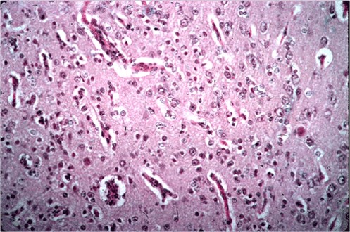 Neospora مخ جنين بقري مجهض بداء النيوسبورا تكاثر الخلايا الدبقية في التهاب المخ