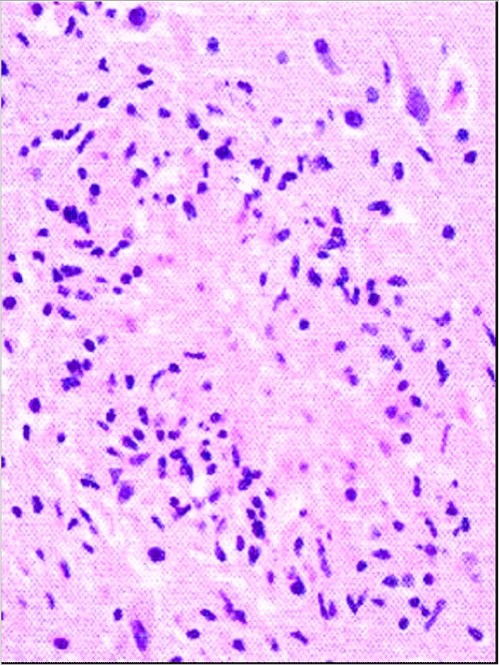 Neospora مخ جنين بقري مجهض بداء النيوسبورا ليونة بؤرية(focal malacia) محاطة بتكاثر من الخلايا الدبقية