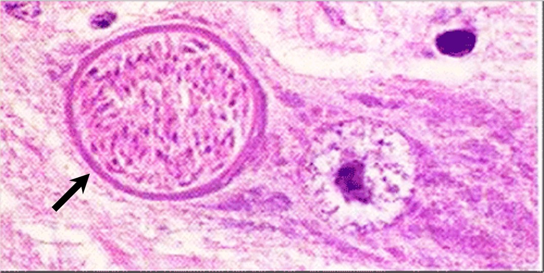 Neospora اجهاض النيوسبورا حويصلة النيوسبورا في خلية عصبية في المخ