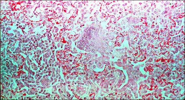 Peste des petitis ruminants طاعون المجترات الصغيره : التهاب الرئة ذو الخلايا العملاقة – مدامج خلوية عملاقة. 