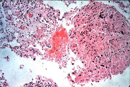 Toxoplasmosis داء المقوسات في مشيمة نعجة موات حاد مع وجود تجمعات من الميكروب