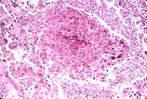 Toxoplasmosis داء المقوسات في مشيمة نعجة مساحات بؤرية من الموات في الفلقات