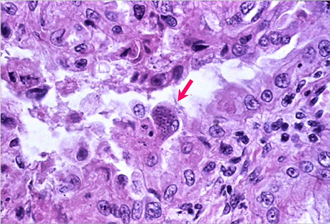 Toxoplasmosis داء المقوسات في مشيمة نعجة حويصلة المقوسات في خلية ام غذائية