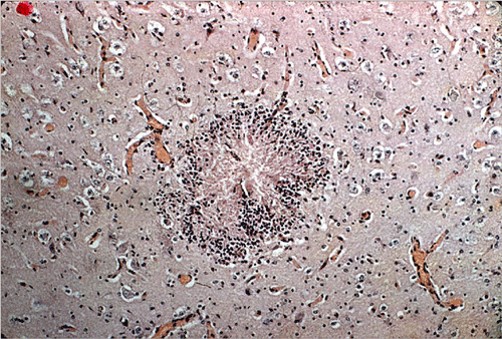Toxoplasmosis داء المقوسات في مخ جنين غنمة التهاب المخ الحبيبومى البؤري