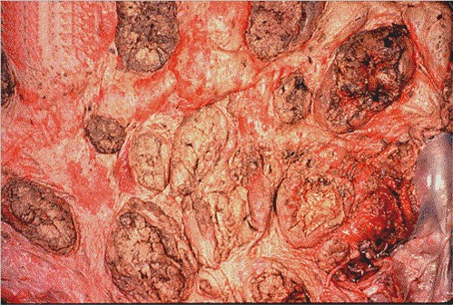 fungal abortion التهاب المشيمة الفطري (الجذريات) يشخص الفطر عن طريف الزرع فقط