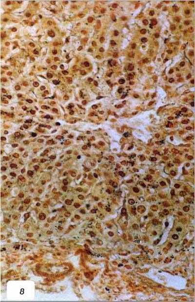 liptospira عجل مجهض نتيجة للإصابة باللولبيات الخيطية : ميكروبات اللولبيات الخيطية داخل خلايا الكبد (صبغة الفضة)