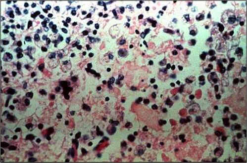 rinderpest طاعون بقرى الغدة الليمفاوية للمساريقا : موات الخلايا فى المركز التوالدى مع وجود مدمج خلوى واحد.
