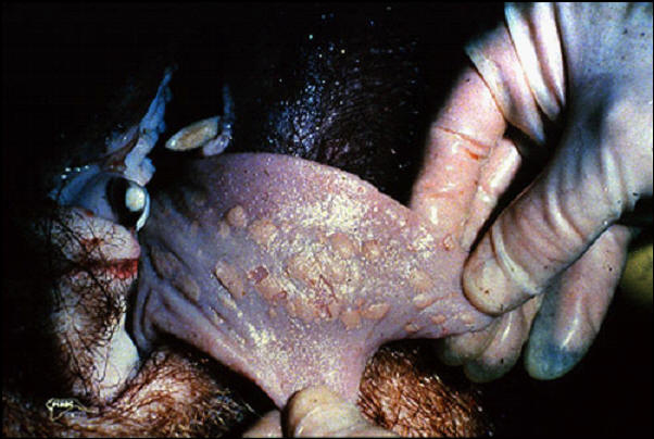 خنزير - مناطق مبيضة على سطح اللسان في اصابات قديمة للحمى القلاعية